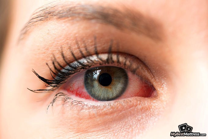 sleeping with eyes open: red eyes